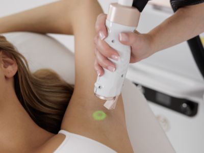 epilation laser