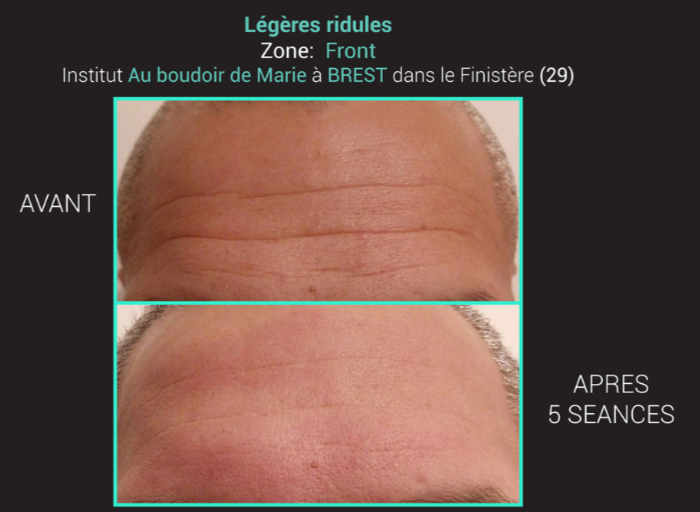 bloomea avant après