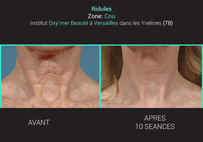 bloomea avant après