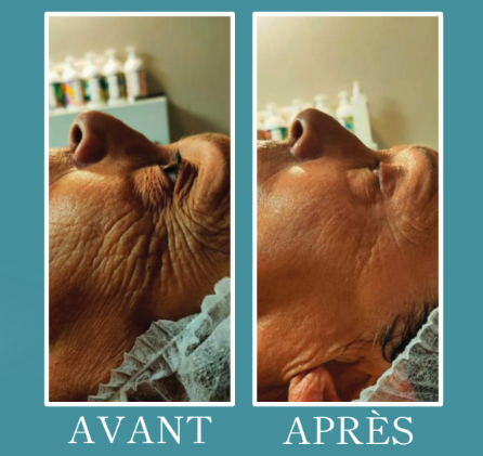 resultat face bloomea visage