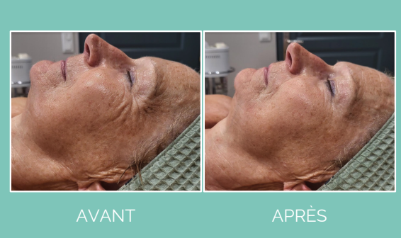 resultat eberline cure